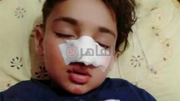 إصابة طفل سقط من