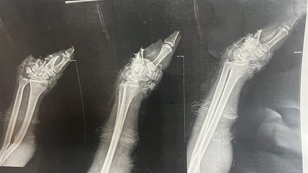 إعادة كف يد شاب مبتورة