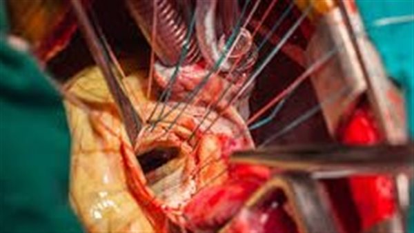 جراحات القلب المفتوح