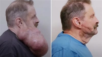 في حجم البطيخة.. أمريكي يخضع لعملية خطيرة بسبب ورما بالوجه استمر 16 عاما