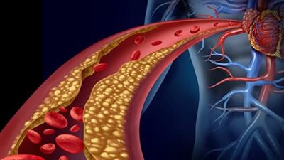 علاجات طبيعية لخفض مستويات الكوليسترول في المنزل
