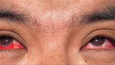 بالتزامن مع موسم الحرارة والرياح.. كيفية تجنب الإصابة بعدوى العين