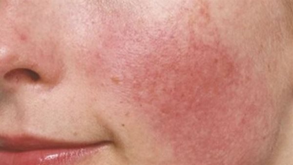 حالة الجلد الوردية