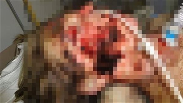 سيدة يتقشر جلدها