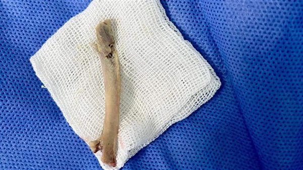 العظمة التي تم استخراجها