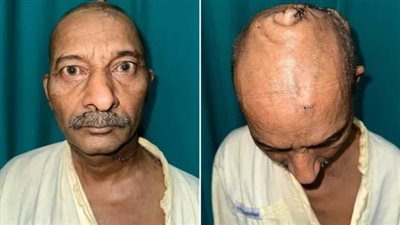 يزن 15 رطلًا.. جراحون هنود ينجحون في إزالة أكبر ورم دماغي لمسن