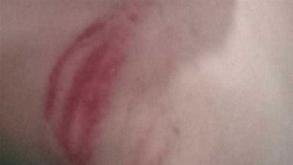 أثر ضرب - أرشيفية