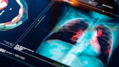 اكتشاف مرض مميت مرتبط بفيروس كورونا في بريطانيا