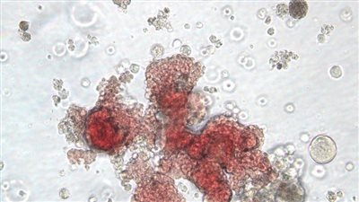 تقرير يكشف تستر بريطانيا على فضيحة الدم الملوث المتسبب في وفاة الآلاف