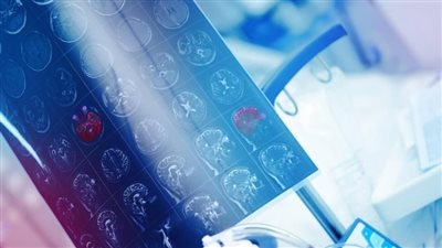 دراسة: جهاز الموجات فوق الصوتية المزروع بالجمجمة يساعد في استهداف أورام المخ