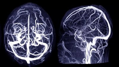أدوية الكوليسترول والسكر ترتبط بانخفاض خطر تمدد الأوعية الدموية في الدماغ | دراسة