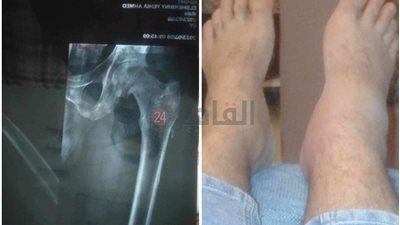 مؤجلة منذ سنة.. رجل يستغيث لإجراء عملية تغيير مفصل الفخذ: بصرف على البيت وأمي 