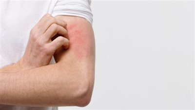 نصائح للحد من الإصابة بالتهاب الجلد خلال فصل الصيف