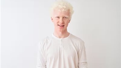 ما هو المهق؟.. تعرف على أعراضه وطرق علاجه