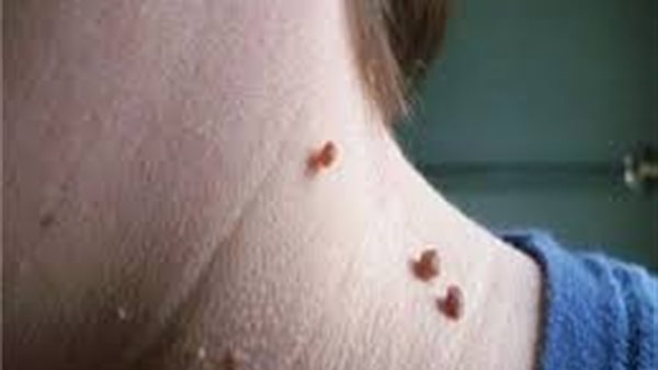 الزوائد الجلدية 