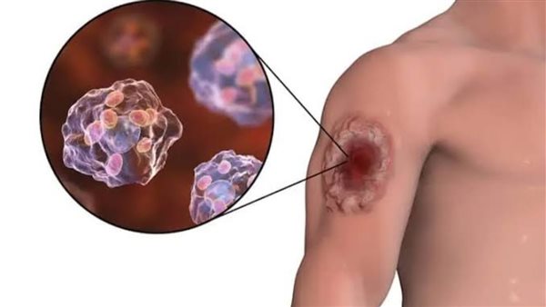 بكتيريا آكلة اللحم