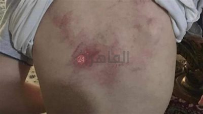 استغلت عجزه عن الكلام.. سيدة تشكو من ضرب أخصائية لنجلها خلال جلسة تخاطب بالإسكندرية