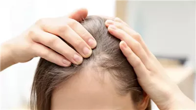 تعرف على سبب الإصابة بالصلع؟ 