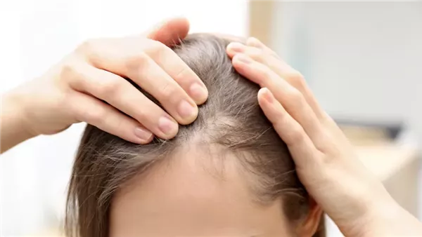 صلع - تعبيرية