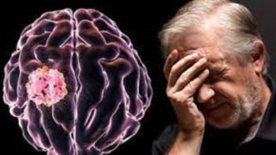 تدابير وقائية للحد من خطر الإصابة بأورام الدماغ.. تعرف عليها 