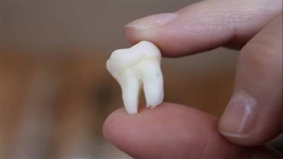 تعرف على أعراض ظهور ضرس العقل ومتى يجب إزالته؟