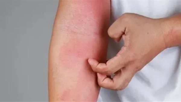 التهابات الجلد