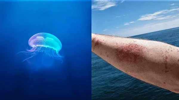 لسعات القناديل 