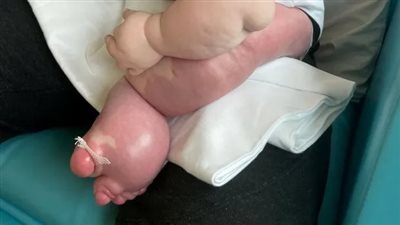 صغير يعاني من طفرة نادرة تتسبب في نمو ساقه بشكل كبير