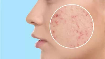 أفضل كريم طبيعي لعلاج حب الشباب في المنزل.. تخلص خلال 48 ساعة فقط