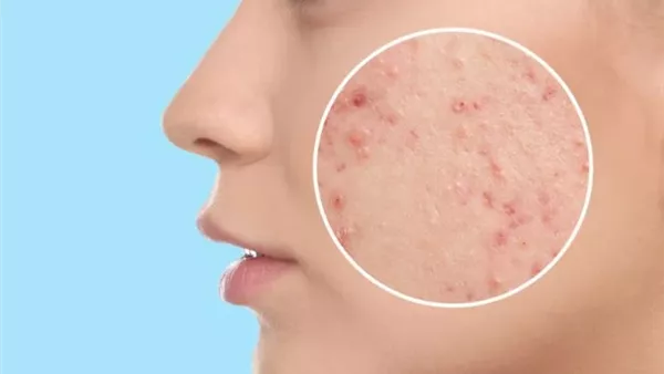 أفضل كريم طبيعي لعلاج