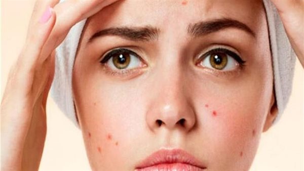 طرق فعالة لعلاج حب