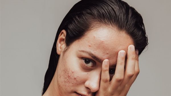 طرق إزالة آثار الحبوب