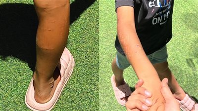 آثار حروق وضرب.. شاب يزعم تعرض أطفال دار أيتام بالهرم للتعذيب | خاص