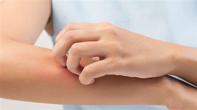التهاب الجلد والعدوى الفطرية.. أنواع الطفح الجلدي وأسباب الإصابة 