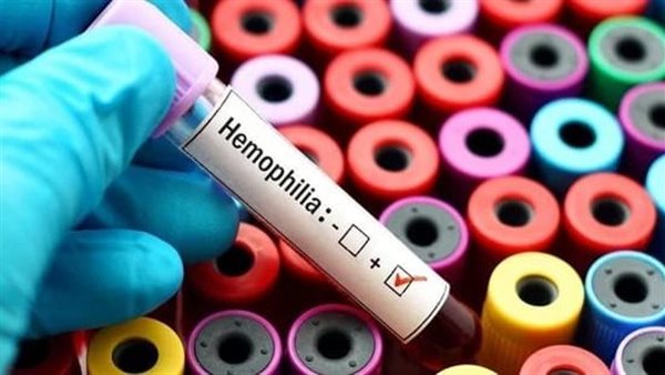 الهيموفيليا 