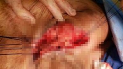  إصابة سيدة عجوز بـ انفجار في الأمعاء بسبب نوبة سعال