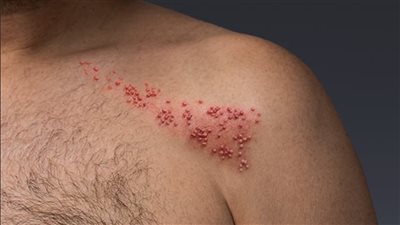 أسباب وعلاج الحزام الناري.. محاذير لمن أصيب بالجدري في الصغر