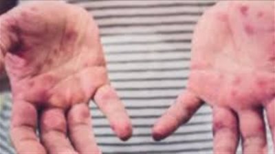 الصحة الأمريكية: انتشار الحصبة في 20 ولاية حتى الآن