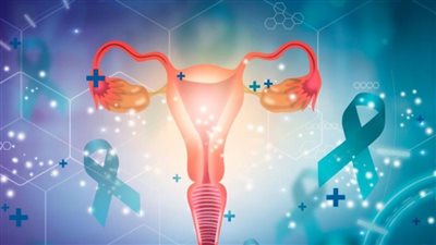 مرض بطانة الرحم يرتبط بارتفاع احتمالات الإصابة بسرطان المبيض | دراسة