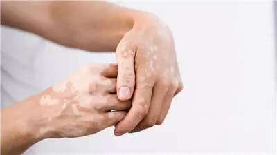 بعد إصابة ابن كيم كارداشيان به.. ما هو البهاق؟