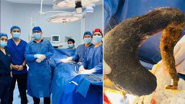 أطباء يستخرجون كتلة