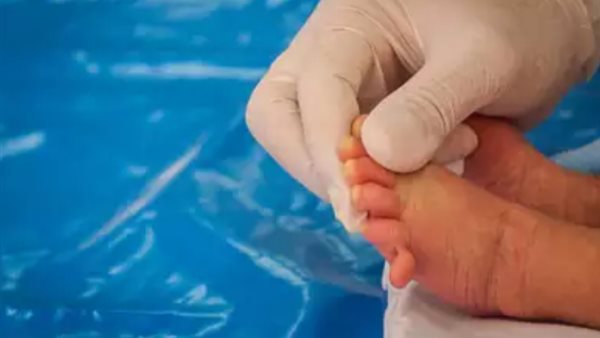  متلازمة الأصابع