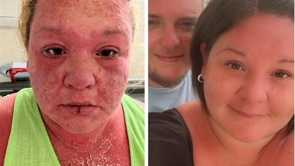 إصابة إيمي ويلز