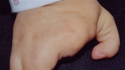 ولادة أطفال دون أصابع بسبب مرض غامض في كوريا الشمالية.. ما القصة؟ 