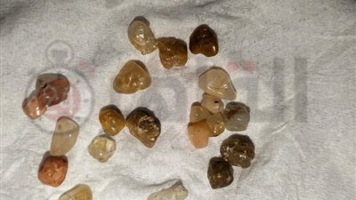 ظاهرة طبية نادرة| والدة صغير بكفر الشيخ: استخرجنا أحجارا كريمة من بطنه.. وطبيب متخصص: حالة أول مرة أشوفها