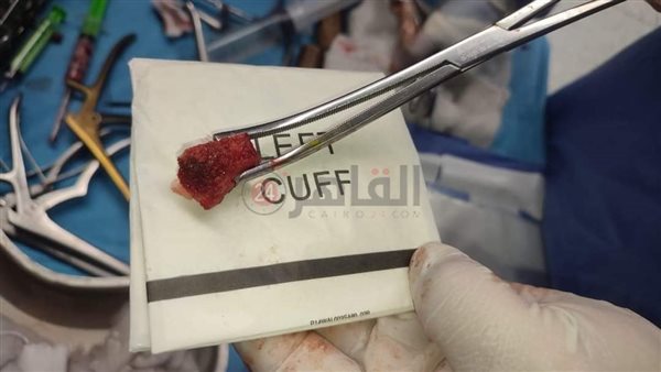 عملية جراحية دقيقة