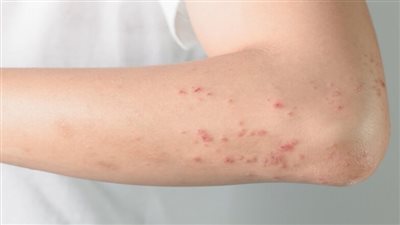 4 حالات جلدية شائعة خلال فصل الصيف.. تعرف عليها