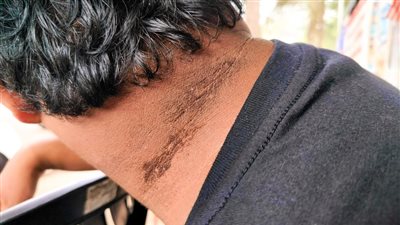 طبيب يحذر من مرض جلدي مرتبط بالسرطان 