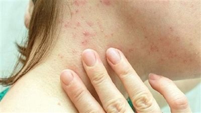 الصحة تكشف عدد حالات الإصابة بجدري القرود خلال السنوات الماضية في مصر | بث مباشر