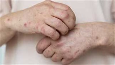 المراكز الإفريقية لمكافحة الأمراض تحذر من تفشي مرض الميبوكس 